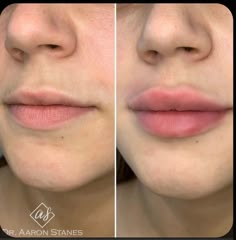 Lip Shapes For Fillers, Madelyn Cline Lips Filler, Good Lip Filler Pictures, Mild Lip Filler, Madelyn Cline Lip Fillers, Top Lip Filler Before And After, Lip Filler Recovery, Lip Filler 2ml, Lip Fillers Before And After 1ml Russian