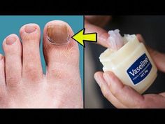 How to Get Rid of Toenail Fungus Fast at Home | 7 Natural Remedies to Treat Fungal ToenailsToenail fungus, also known as onychomycosis. It is a fungal infect... Black Toe Nails, Nail Infection, Fungal Nail, Fungal Infection, Get Nails, Healthy Nails