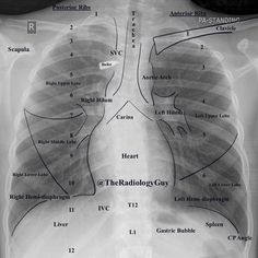 an x - ray shows the location of the heart and lungs in this chest diagram