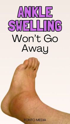 Swollen Ankles Remedies, Ankle Swelling Remedies, Swollen Ankle Remedies, Swelling In Feet And Ankles Remedies, Swelling Feet Remedies, Reduce Ankle Swelling, Ankle Surgery Recovery, Ankle Swelling, Ankle Pain Relief