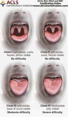 four different stages of an open mouth with the words class iv, class iv and class iv