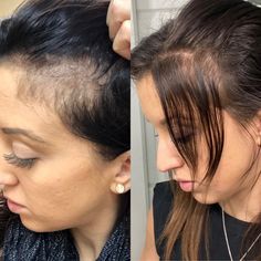 https://maggy94.mymonat.com Toppik Hair Fibers Before And After, Hair Growth After Chemo Pictures, Hair After Extensions Removed, Before And After Hair Transplant, Hair Growth Formula, Skin And Hair Clinic, Hair Transplant Cost, Cartoon Clouds