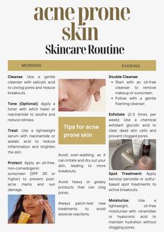 #acneproneskin #acne #acneproneskinroutine #skincare #skincaretips #skincareroutine Skincare For Dry Acne Prone Skin, Combination Acne Prone Skin Care Routine, Dry Acne Prone Skin Routine, Acne Black Women, Acne Skincare Routine Products, Acne Prone Skincare Routine, Acne Chart, Skincare For Acne Prone Skin, Skincare For Acne Prone