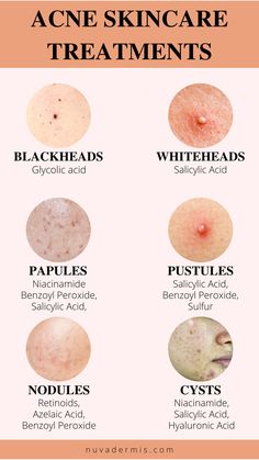 Different Types Of Acne, Acne Patches, Acne Skincare, Natural Acne Remedies, Types Of Acne, Perfect Skin Care Routine, Healthy Skin Tips