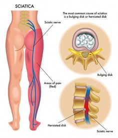 Article Reviewed &amp; Updated on 9/8/2022 Medical Reviewer: Kari Haberman - DPT   Sciatica affects 40% of people in the course of their lifetime. In fact, it is one of the most common reasons why people seek medical attention in the United States and around the world. In this article, we will provide &amp; discuss a c Bolesti Chrbta, Piriformis Syndrome, Sciatica Pain, Relieve Back Pain