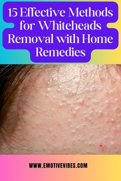 Human skin changes over time due to hormonal changes. Especially teenage skin can suffer from many skin problems, including whiteheads. White Heads Removal Remedies, Whiteheads Removal Remedies, Chin Whiteheads, Whiteheads Removal, Small Pimples, Diet Schedule, Prevent Pimples, Aloe Vera For Hair, How To Get Rid Of Pimples