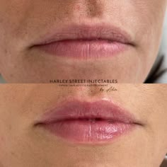 Lip Filler Natural Look, Light Lip Filler, Subtle Lip Filler Before And After, Lip Flip, 0.5ml Lip Filler Before And After, Hyaluron Pen Lip Filler