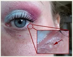 Bump On Eyelid, Lower Eyelid Makeup, Millia Removal, White Bump On Eyelid, Pimple On Eyelid, Bumps Under Eyes, Remove Skin Tags Naturally, Blind Pimple, Pimples Under The Skin