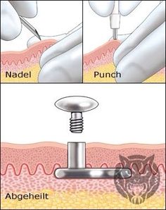 the procedure is performed to treat and remove hair