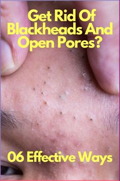 If you want to remove blackheads from skin, you have to treat open skin pores first.The best and effective solution is home remedies for blackheads and open pores problem. In this article, you will learn the best home remedies for blackheads and open pores. #blackheads #blackheadsandopenpores #openpores #blackheadsandopenporestreatment #blackheadsandopenporeshomeremedies #blackheadsandopenporescauses #blackheadsandopenporesprevention Solution For Blackheads, Pore Extraction Diy, How To Remove Open Pores, Black Head Removal Video Nose, How To Treat Blackheads, Remedies For Blackheads, February Nail Colors, Skincare On A Budget