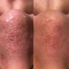 12 Dermaplaning Benefits - Why You Need to Try This Facial Before And After Dermaplaning, Benefits Of Dermaplaning, Dermaplaning Before And After, Dermaplaning Benefits, Facial Dermaplaning, Dermaplaning At Home, Facial Before And After, Dermaplaning Facial, Cosmetic Procedures