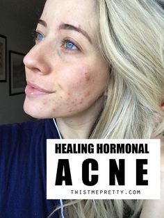 Hey babes!  Today I’m finally sharing my acne story.  And it’s a long one — I apologize in advance.  I’m going to be as concise as possible but for those dealing with acne, I think a few details and timelines of things might be helpful to read.  And BTW, if you’re new here, I’m Abby! ... Cystic Hormonal Acne, How To Help Hormonal Acne, How To Clear Up Acne, Hormone Acne, Hormonal Acne Skincare Routine, Clear Hormonal Acne, Postpartum Acne, Medical Remedies, Hormonal Acne Supplements