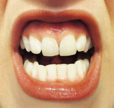 a close up of a person's mouth with white teeth