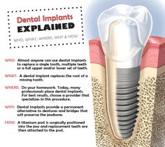 Dental Implants Explained Dentistry Quotes, Surgeon Humor, Dental Assistant School, Tooth Implant, Dental Assistant Study, Denture Implants, Dental Implant Surgery, Oral Surgeon