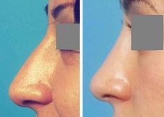 Nose Plastic Surgery, Rhinoplasty Nose Jobs, Nose Reshaping, Job Inspiration, Pretty Nose, Lipstick For Fair Skin, Perfect Nose, Nose Surgery, Reconstructive Surgery