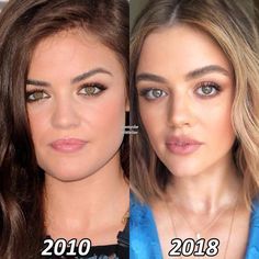 Kylie Jenner Plastic Surgery, Lips Inspiration, Lucy Hale Style, Strong Jawline, Plastic Surgery Gone Wrong