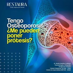 La osteoporosis es un padecimiento cada vez más común en nuestra población, sobre todo en mujeres arriba de 60 años, aunque también se presenta en hombres. La pregunta es ¿Me puedo poner #prótesis de rodilla o de cadera si tengo #osteoporosis? https://youtu.be/DBss_OqP8Kw