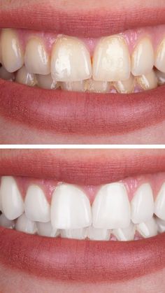 Teeth Whitening At Home, Teeth Whiting At Home, Elegant Shoes Heels, Dental Photos, Dentist Visit, Whiten Your Teeth, Teeth Health, White Smile, The Dentist