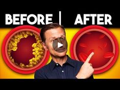 The Best MEAL to Clear Out Your Arteries - Dr. Eric Berg DC | The Best MEAL to Clear Out Your Arteries - Dr. Eric Berg DC | By Dr. Eric Berg DC - Your doctor | Let's talk about the best meal
that you could eat to help reduce plaqueing in your
arteries or even help prevent cardiovascular disease. Now,
I've done a lot of videos on what to avoid to prevent heart
disease. Today, I'm going to primarily focus on what to eat,
okay? But we first have to give you a little background of what
is going on behind the scenes as far as a cardiovascular
disease and primarily we're going to talk about plaque.
Now, what is in plaque Plaque is a combination of calcium,
protein, and cholesterol. Uh many times the calcium is a
result of biofilms. So, what's a biofilm? It's a colony of
microbes that these micro Nutrition Videos, Artery Cleanse, Cardiovascular Disease, Alternative Health, What To Eat, Let's Talk About