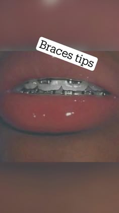 The Best Braces Colors To Get, What Colour Braces Should I Get, Baddie Braces Colors Ideas, Prettiest Braces Colors, Braces Colors Combinations Summer, Pretty Braces Colors Summer, Braces Color For Brown Skin