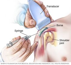 Shoulder Bursitis, Shoulder Muscle Pain, Bursitis Shoulder, Medical Coding And Billing, Shoulder Muscle, Bursitis Hip, Rotator Cuff Injury, Interventional Radiology, Pain Relief Remedies