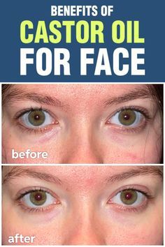 Castor Oil Before And After, Castor Oil On Face Overnight, Castor Oil On Face, Castor Oil For Wrinkles, Castor Oil Skin, Castor Oil For Face, Wrinkles Around Mouth, Castor Oil Uses, Castor Oil For Skin