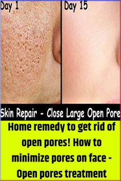 Home remedy to get rid of open pores! How to minimize pores on face - Open pores treatment #openpores #largepores Big Pores On Face Remedies, Remedies For Pores On Face, Facial Pores Remedies, How To Minimize Pores Naturally, Remedies For Open Pores On Face, Get Rid Of Big Pores On Face, How To Treat Pores On Face, How To Treat Open Pores On Face, Reduce Open Pores On Face