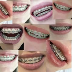 😬😬 Perfect Teeth Braces, Teeth Aesthetic, Braces Tips, Getting Braces, Orthodontic Appliances, Dental Braces