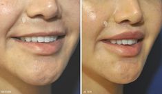 Lip Lift Sydney | Before and After Gallery | Dr Warwick Nettle Upper Lip Lift Before And After, Lip Lift Before And After, Face Plastic Surgery, Lip Surgery, Lip Lift, Face Surgery, Cheek Fillers, The Surgeon, Facial Fillers