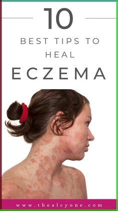 Eczema flare-ups causing you stress? Learn 10 powerful tips to heal your skin and restore comfort quickly. From gentle skincare to home remedies, these tips are your go-to guide for managing eczema effectively. Click to find out how to soothe your skin naturally! Gentle Skincare, Skin Detox, Face Wrinkles, Holistic Beauty, Sensitive Skin Care, Itchy Skin, Aging Skin Care, Lifestyle Changes, Anti Aging Skin Care