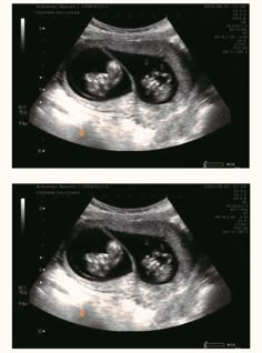 Usg Pregnancy Photography, 10 Week Ultrasound Pictures, Twin Ultrasound, Mom Pictures, Hello Kitty Coloring, Prenatal Care