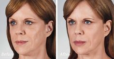 https://flic.kr/p/DQnZ5U | Volbella Lip Filler | Volbella Lip Filler Dr. John L. Burns, Jr., MD Board Certified Plastic Surgeon President, Dallas Plastic Surgery Institute Blue Eye Makeup Tutorial, Character Change, Makeup Organization Vanity, Unicorn Makeup, Glowy Makeup