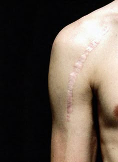 the back of a man's shoulder with stitches on his left arm and chest