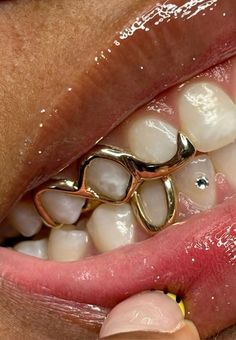 a woman's mouth with gold teeth and braces