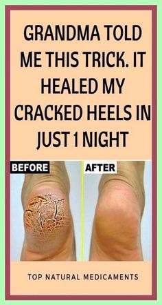 Best At Home Remedy For Dry, Cracked Feet~ Cure Dry, Cracked Feet Feet Scrub, 1st Night, Holistic Wellness, Health Advice, Healthy Living Tips, Warning Signs