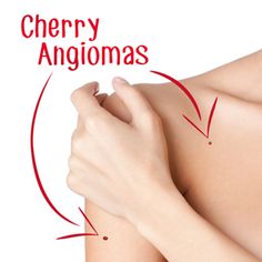 Red Dots on Your Skin … What Can You Do? | Beautiful on Raw Cherry Angioma Removal, Red Skin Spots, Mole Meaning, Red Freckles, Red Moles, Remove Skin Tags Naturally, Skin Moles, Mole Removal, Skin Spots