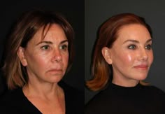 Stunning deep plane facelift results before and after photos from New York top facial plastic surgeon, Dr. Andrew Jacono Deep Plane Facelift, Face Plastic Surgery, Facelift Before And After, Sagging Cheeks, Facelift Procedure, Laser Skin Resurfacing, Face Lift Surgery, Fractional Laser, Facial Fillers