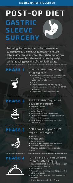 Sleeve Gastrectomy Diet, Gastric Bypass Sleeve, Diet Infographic, Stomach Sleeve, Vertical Sleeve Gastrectomy