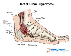 Heal Spur Remedies, Tibial Plateau Fracture, Heel Pain Relief, Swollen Ankles, Yoga Anatomy