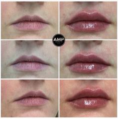 Lips Goals, Mini Face Lift, Mommy Makeover, Lip Injections, Face Lift, Female Anatomy