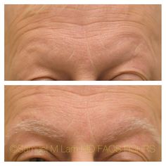 This 59-year-old gentleman who suffered in the past from trichotillomania is shown before and four months after eyebrow hair transplant with a good aesthetic outcome.