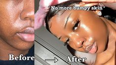 Textured Bumpy Skin, How To Get Rid Of Skin Texture, Flaky Skin On Face, Smooth Skin Face, Everyday Skincare Routine, Everyday Skin Care Routine, Everyday Skincare