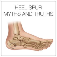 Exercises For Heel Spur, Heel Spur, Heel Spur Symptoms, Heal Spur Remedies, Bone Spur On Back Of Heel, Foot Spurs Remedies Heel Pain