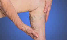 an old woman holding her lower leg with both hands and touching the knee area on a blue background