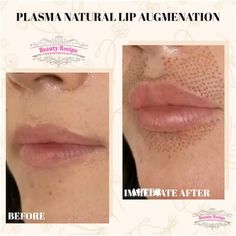 Lip Flip Fibroblast, Lift Contour, Plasma Fibroblast, Skin Mapping, Lip Flip, Skin Tightening Procedures, Medical Esthetician, Pouty Lips