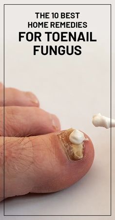 The 10 Best Home Remedies for Toenail Fungus Toenail Fungal Infection, Nail Remedies, Toenail Fungus Remedies, Nail Fungus Remedy, Nail Infection, Fungal Nail, Ingrown Toe Nail, Toenail Fungus, Nail Fungus