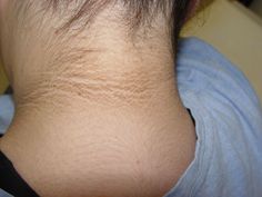 Acanthosis Nigricans, Dark Rings, Tan Removal, Crepey Skin, Cosmetics Industry, Skin Allergies, Bye Bye, Esthetician, Beauty Trends