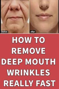 Cheek Wrinkles, Wrinkle Free Skin, Lip Wrinkles, Face Wrinkles