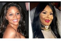 Lip Surgery, Bad Plastic Surgeries, Plastic Surgery Fail, Plastic Surgery Photos, Plastic Surgery Gone Wrong, Nose Surgery, Facial Plastic Surgery