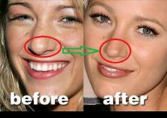 Blake Lively Nose, Nose Inspiration, Ideal Nose Rhinoplasty, Bulbous Tip Rhinoplasty, Tip Plasty Nose, Face Plastic Surgery